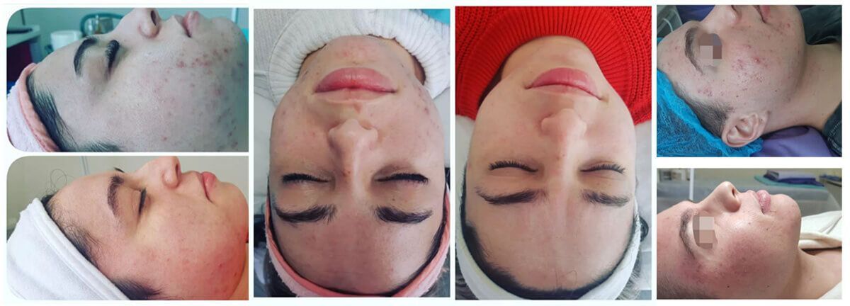 Tratamientos de limpieza de cutis en el consultorio estético Virginia Gil, en Montevideo, Uruguay